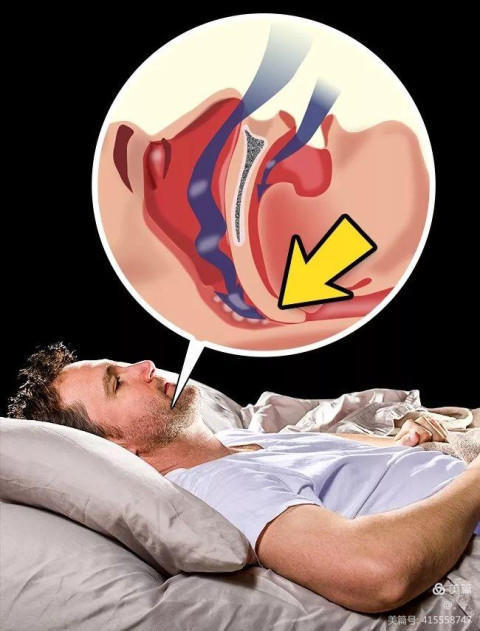 多导睡眠监测——帮您找到睡不好的“元凶”