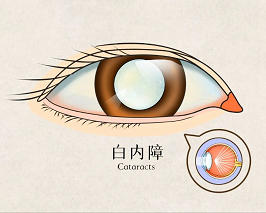健康科普 ▏关注白内障，重现新“视”界